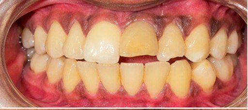 Before photograph for Front spacing at The Dental Hut in Airoli. Not a named patient.