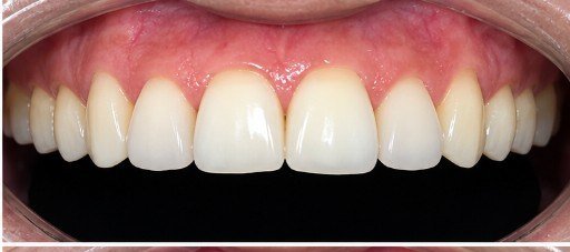 After photograph for Front teeth at The Dental Hut in Airoli. Not a named patient.