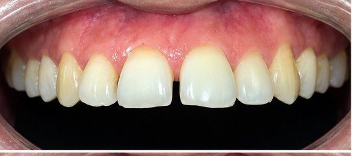 Before photograph for Front teeth at The Dental Hut in Airoli. Not a named patient.