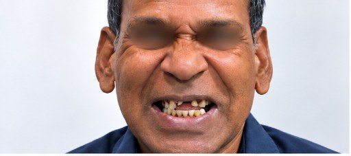 Before photograph for Missing teeth at The Dental Hut in Airoli. Not a named patient.