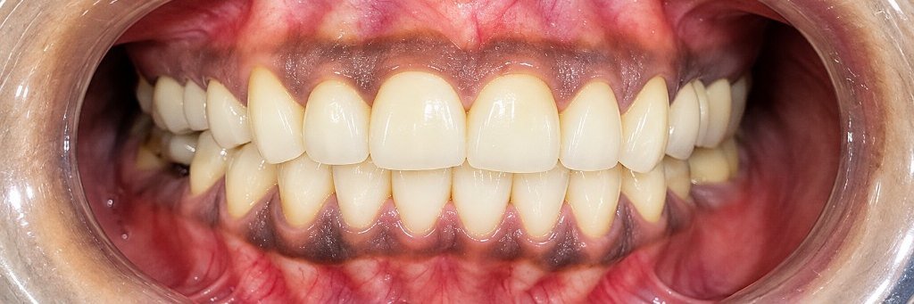 After photograph for Shade and surface at The Dental Hut in Airoli. Not a named patient.