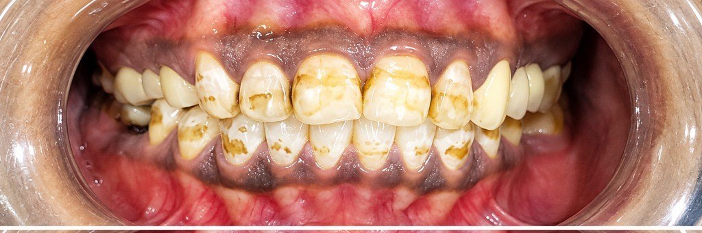 Before photograph for Shade and surface at The Dental Hut in Airoli. Not a named patient.